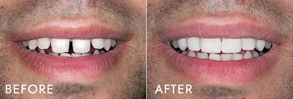 The image shows a before-and-after comparison of a person s smile, with the before showing teeth stained with tobacco and the after displaying clean, white teeth after dental treatment.