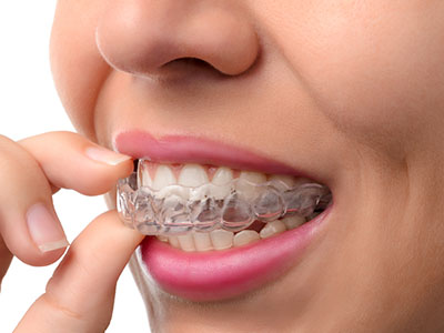 A woman with a clear aligner over her teeth, inspecting it closely.